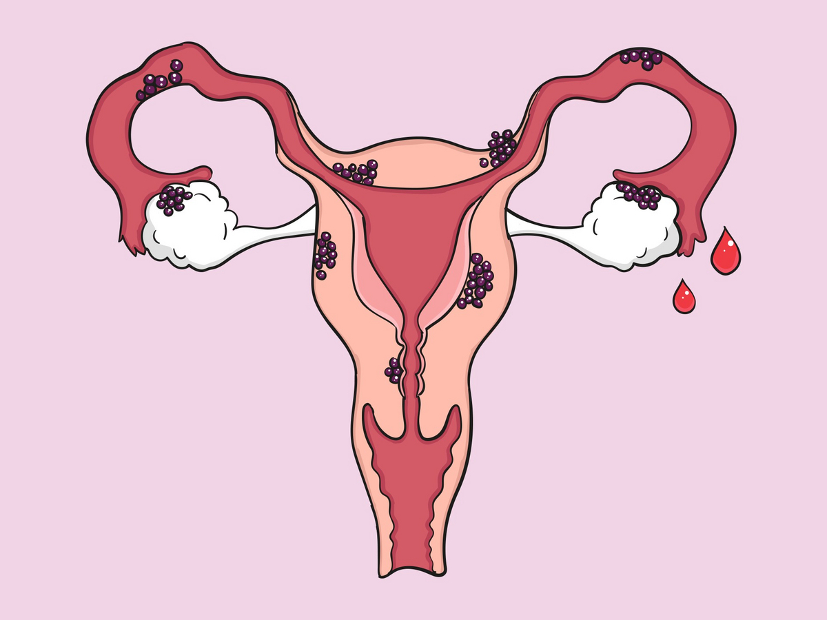 Endometriose MaeganAniello Endometriose MaeganAniello